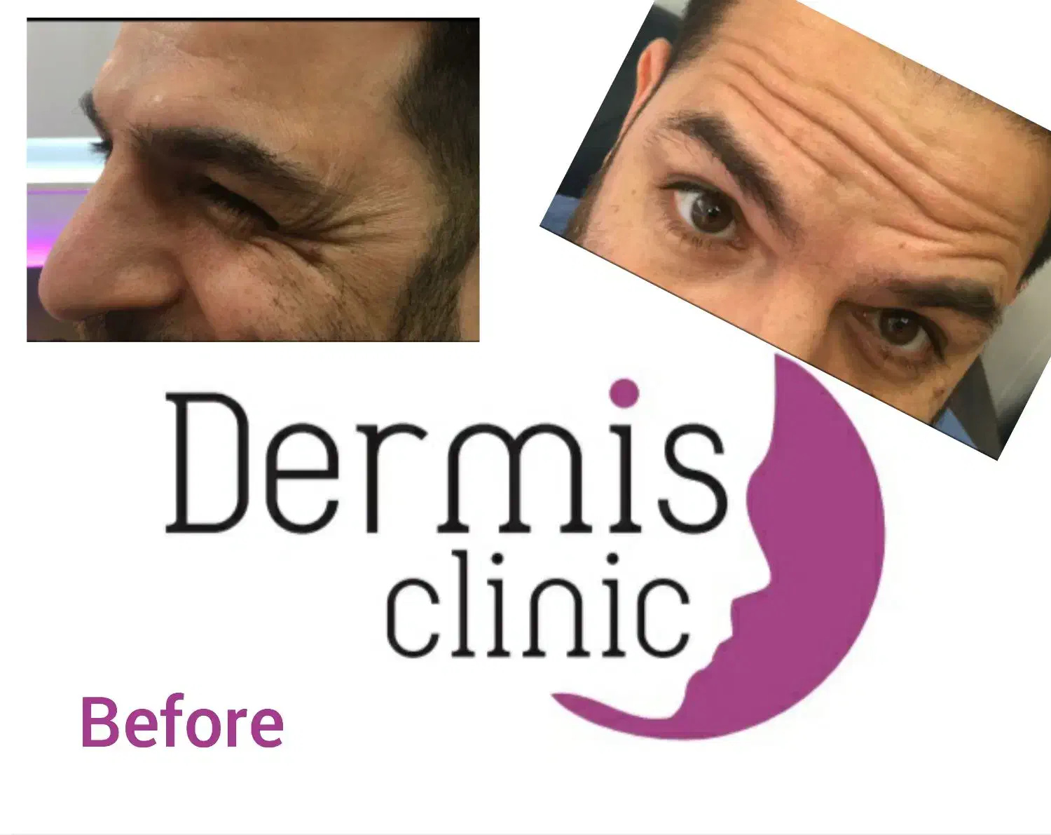 بوتاکس  فول فیس مصپورت اصلی ۵۵۰تومن بشرط اصالت|خدمات آرایشگری و زیبایی|ری, دولت‌آباد|دیوار