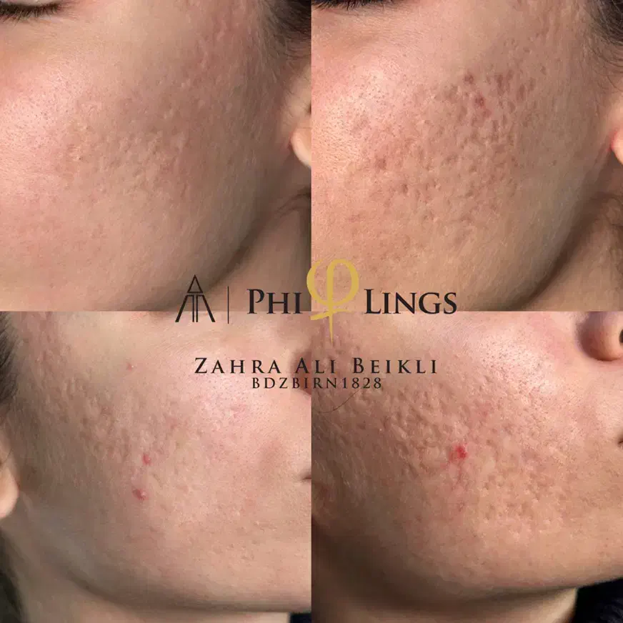 رفع تخصصی جای جوش|خدمات آرایشگری و زیبایی|تهران, قبا|دیوار