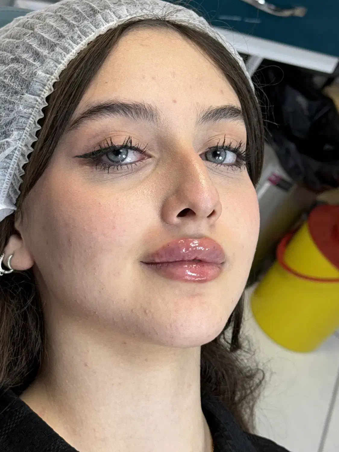 تزریق ژل بوتاکس هایفوتراپی بلفاروپلاستی توسط پزشک|خدمات آرایشگری و زیبایی|تبریز, |دیوار