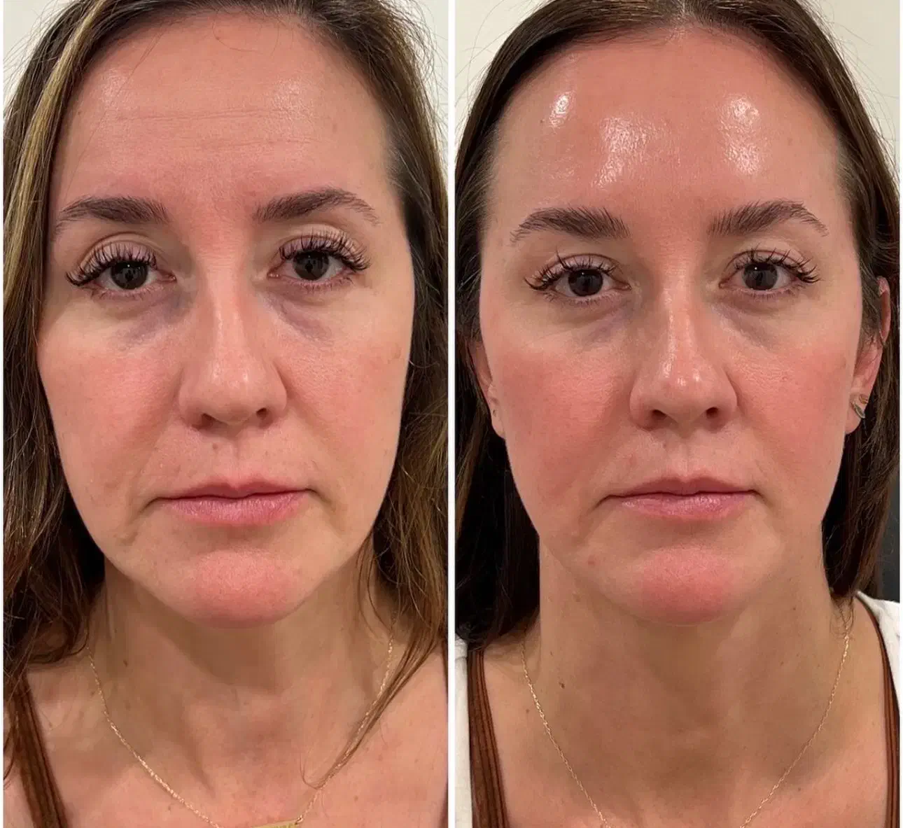 جذب مدل جهت امور زیبایی و فیلر ها|خدمات آرایشگری و زیبایی|تنکابن, |دیوار