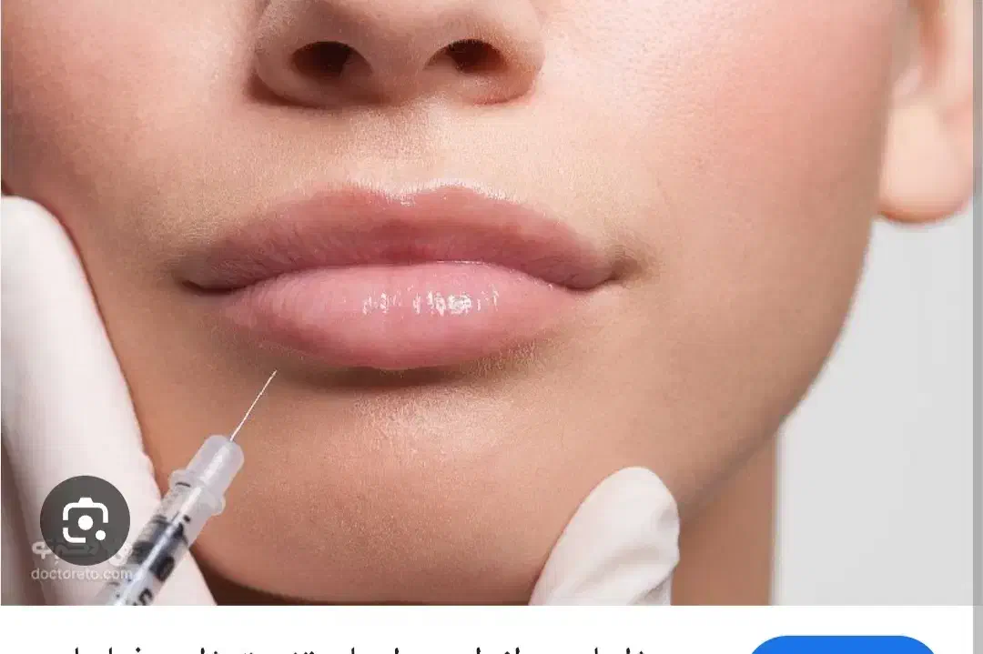 بوتاکس و جوانسازی و ژل توسط پزشک با تخفیف|خدمات آرایشگری و زیبایی|بوشهر, |دیوار