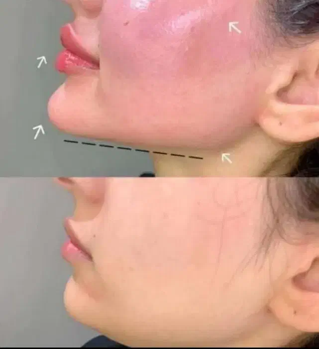 مزو،بوتاکس|خدمات آرایشگری و زیبایی|مشهد, ایثار|دیوار