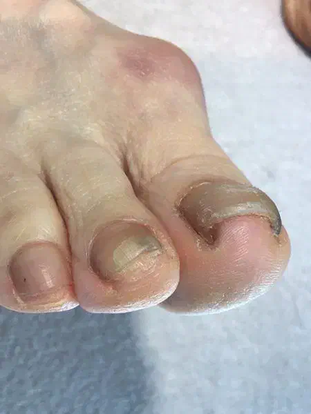 کفسابی پا.درمان ناخن پا.میخچه. ارتونیل ناخن پا|خدمات آرایشگری و زیبایی|کرج, کوی امامیه|دیوار