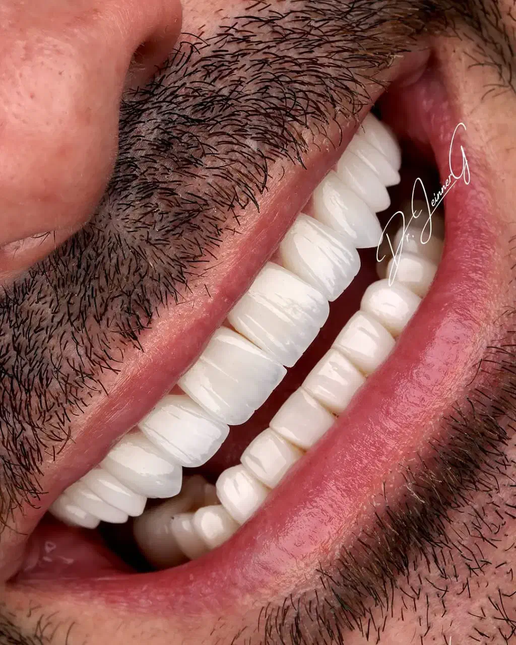 دندان مصنوعی تحویل( ۵ساعته)،کامپوزیت دندان ، روکش|خدمات آرایشگری و زیبایی|تهران, میدان ولیعصر|دیوار