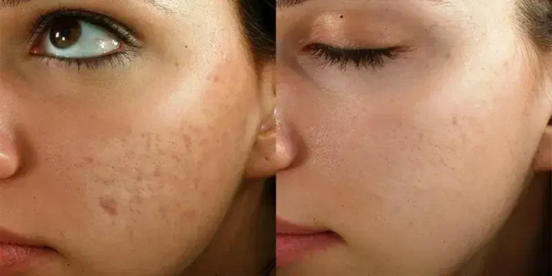 فیشیال و پاکسازی صورت جشنواره یلدایی|خدمات آرایشگری و زیبایی|شیراز, شهرک مهدیه|دیوار