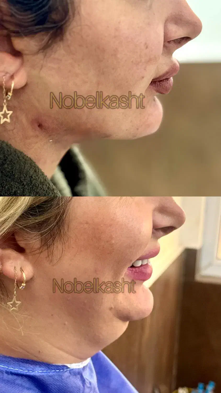 بلفاروپلاستی|خدمات آرایشگری و زیبایی|ارومیه, |دیوار