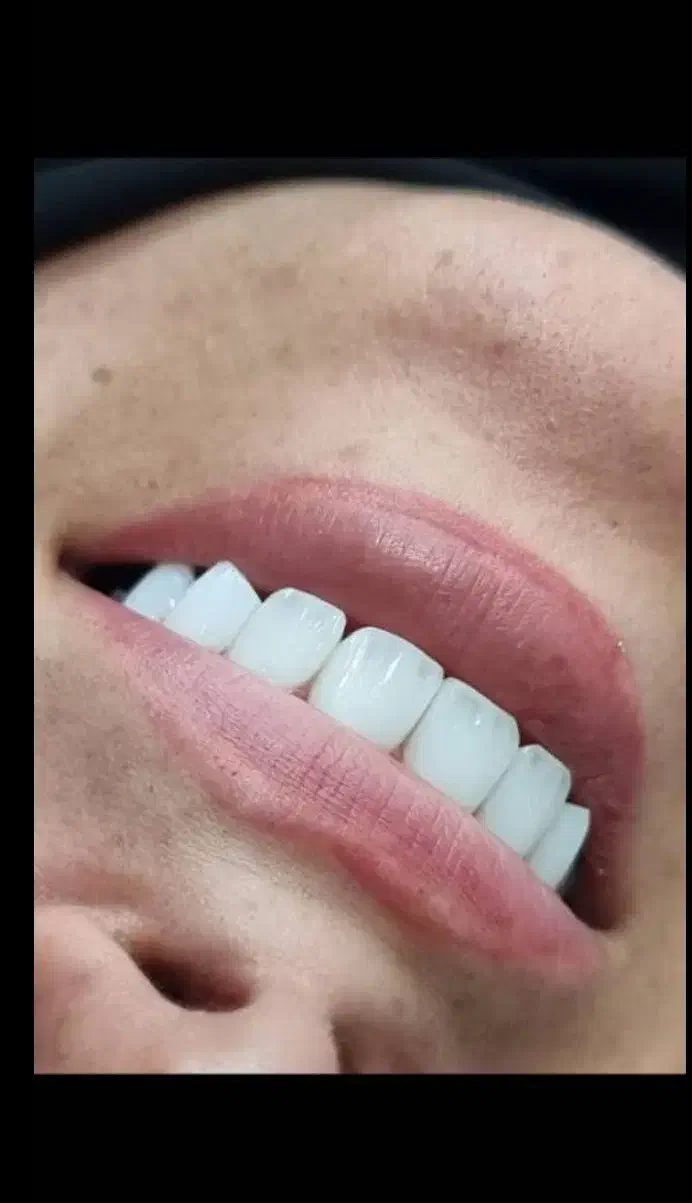 کامپوزیت لمینت روکش|پزشکی|ری, شهرری|دیوار