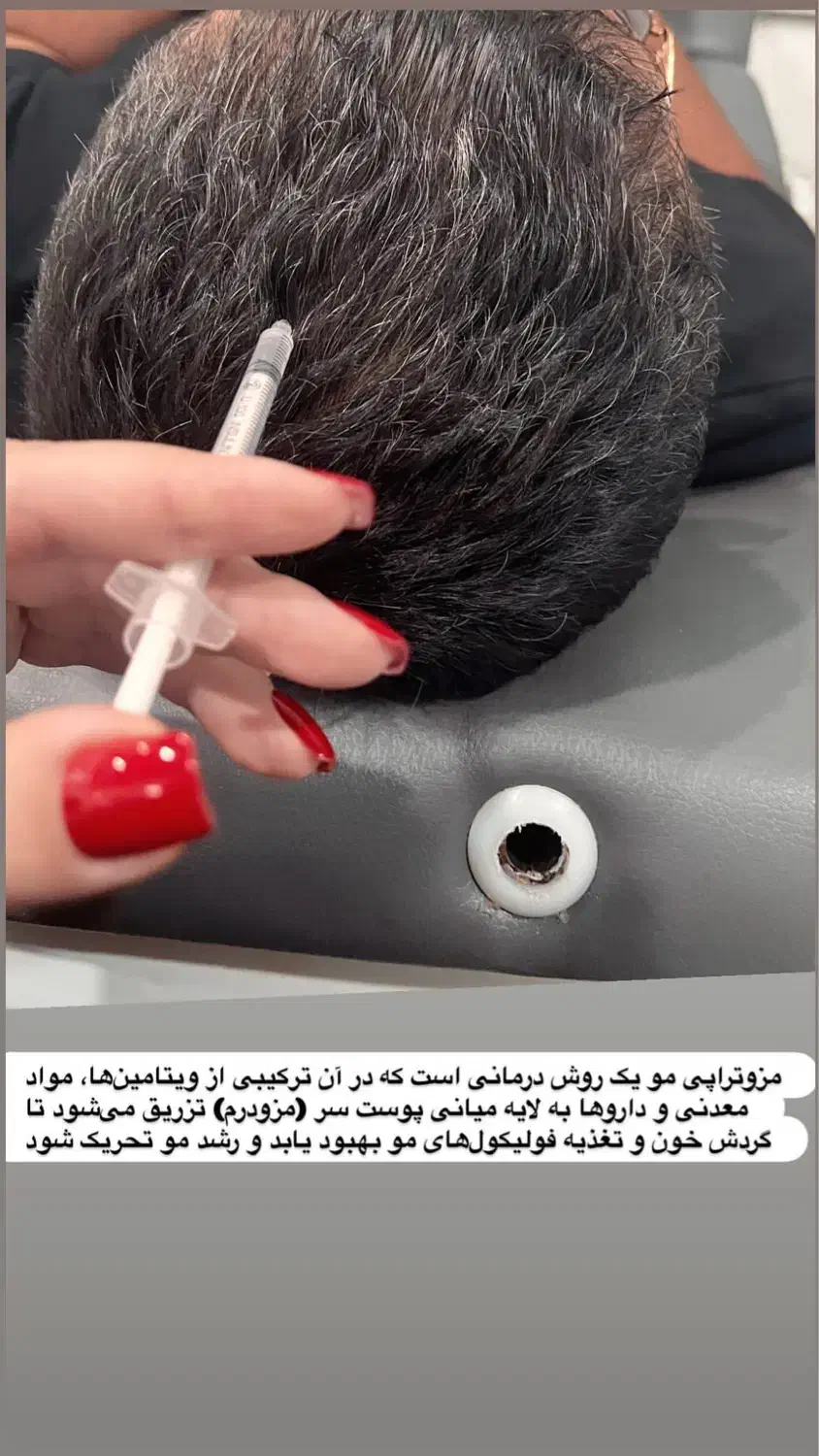 مزوتراپی مو ،برای خانمهاواقایان در کلینیک دی|خدمات آرایشگری و زیبایی|کرمانشاه, |دیوار