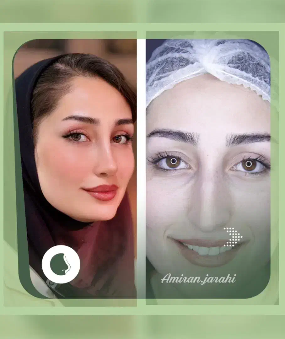 عمل بینی/ جراحی بینی|خدمات آرایشگری و زیبایی|شیراز, تاچارا|دیوار