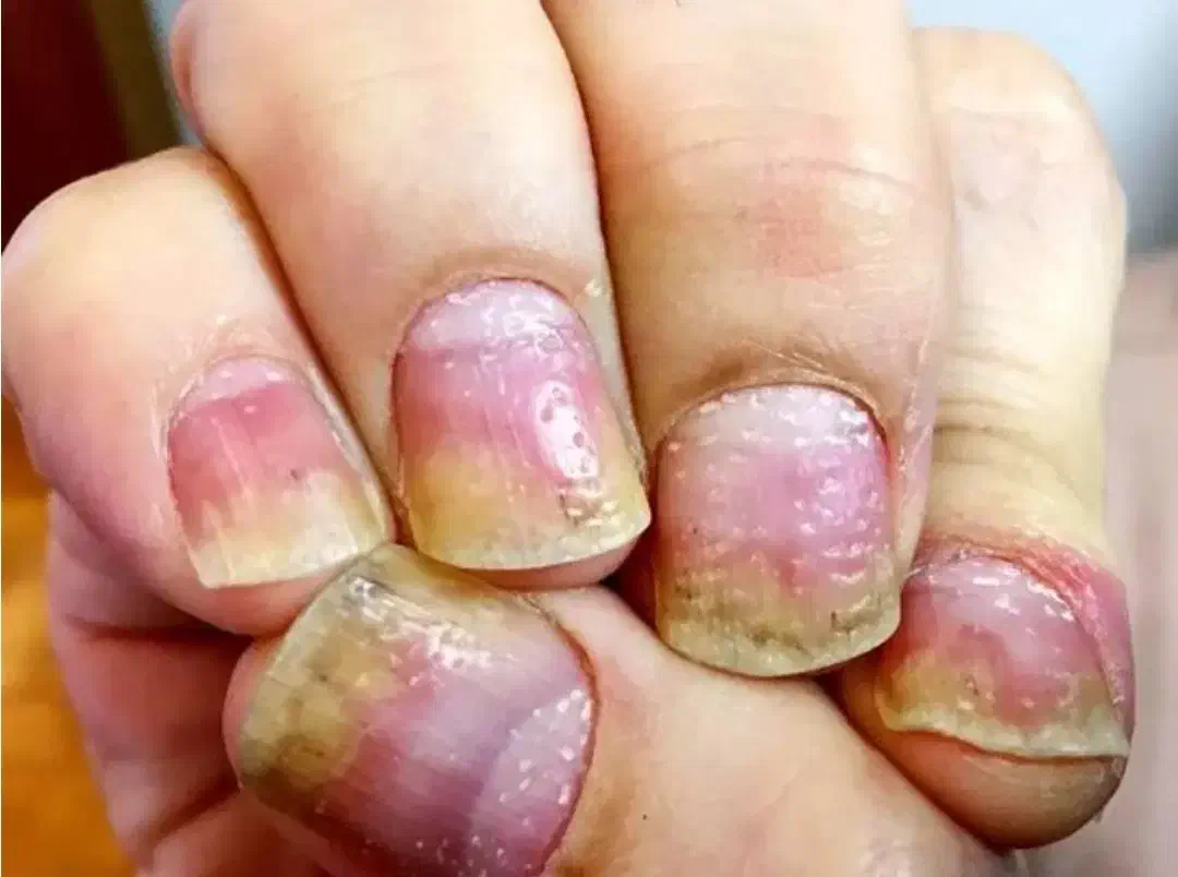 درمان پسوریازیس وصدف|آرایشی، بهداشتی، درمانی|بندر کنگان, |دیوار