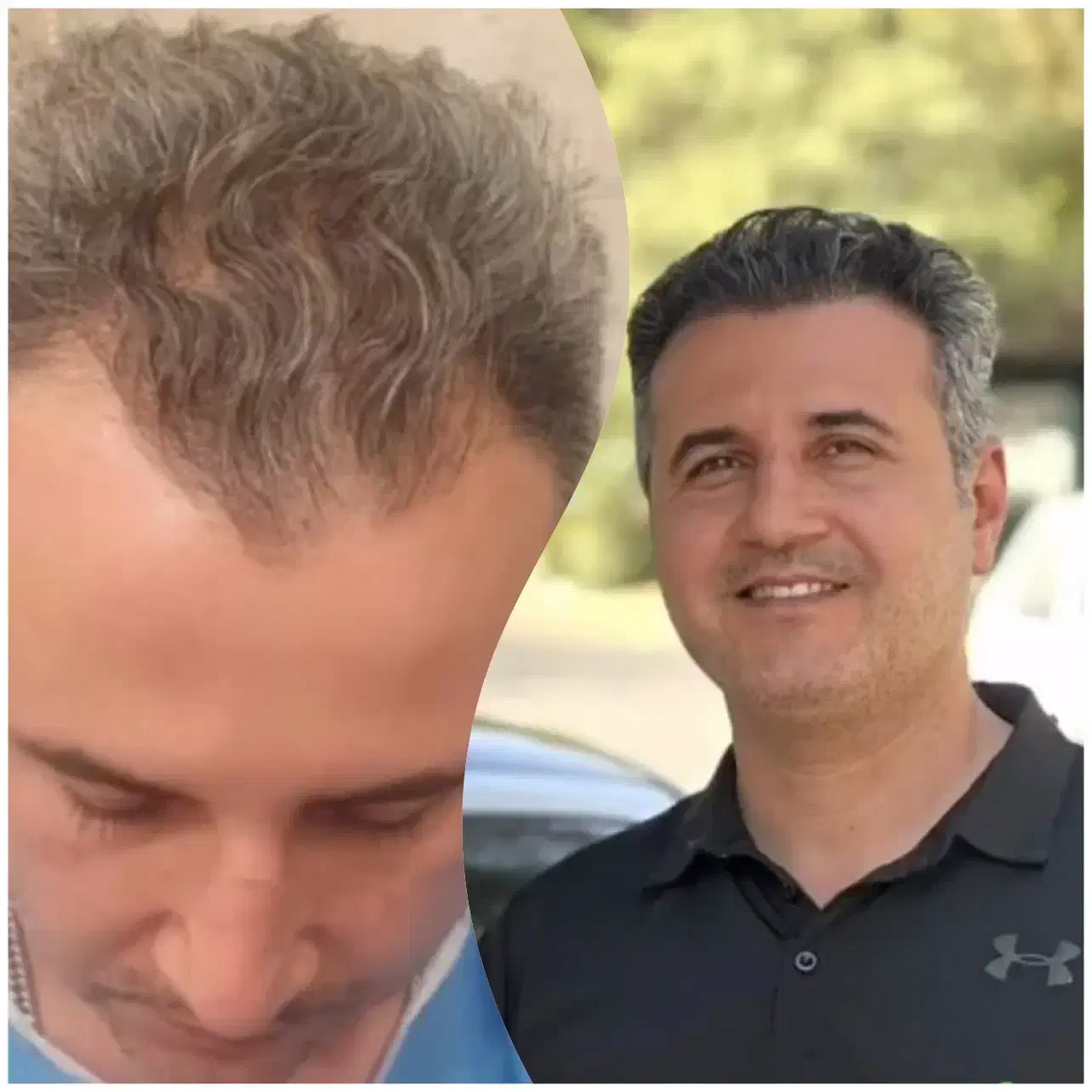 روش جدید بدون جراحی فول تراکم|خدمات آرایشگری و زیبایی|آمل, |دیوار