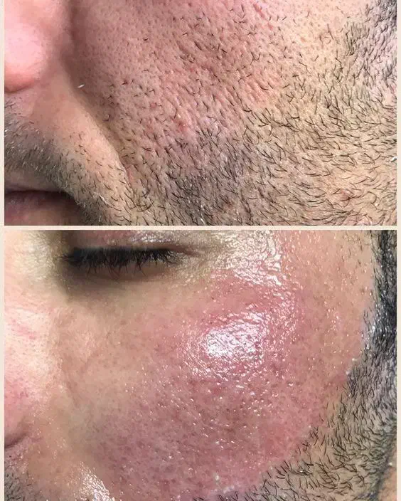 لیزر لک کک و مک و رفع تتو ولیزرموهای زاید|خدمات آرایشگری و زیبایی|نسیمشهر, |دیوار