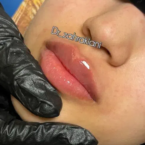 مدل ژل لب(رایگان،تزریق توسط پزشک،با بهترین متریال)|خدمات آرایشگری و زیبایی|اصفهان, گلزار|دیوار