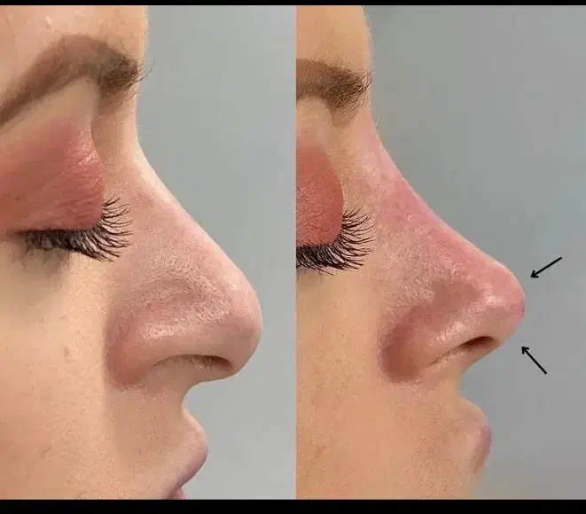 تخصص حرفه ای تزریق لب روسی|خدمات آرایشگری و زیبایی|ارومیه, |دیوار