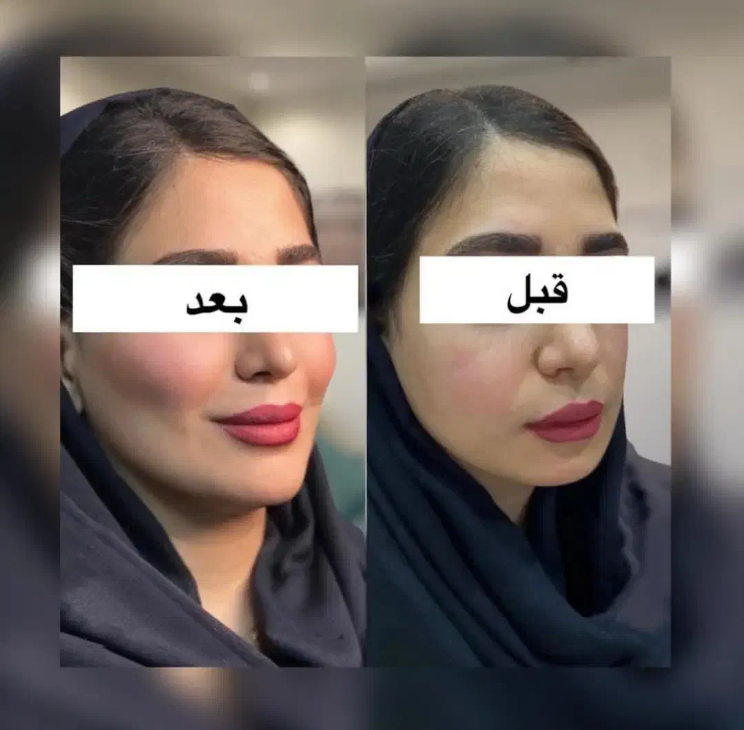 ژل لب زاویه چانه گونه مزوبوتاکس پی ارپی لیزرموزائد|خدمات آرایشگری و زیبایی|مشهد, دانشجو|دیوار