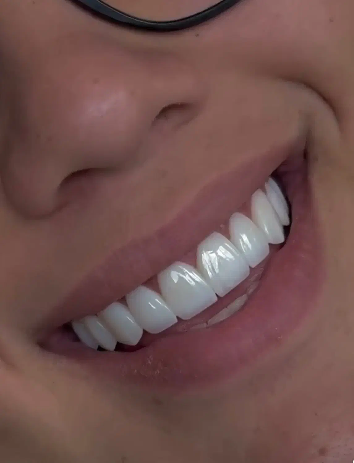 جشنواره کامپوزیت دندان و ترمیم کامپوزیت|خدمات آرایشگری و زیبایی|کرج, کوی کارمندان شمالی|دیوار