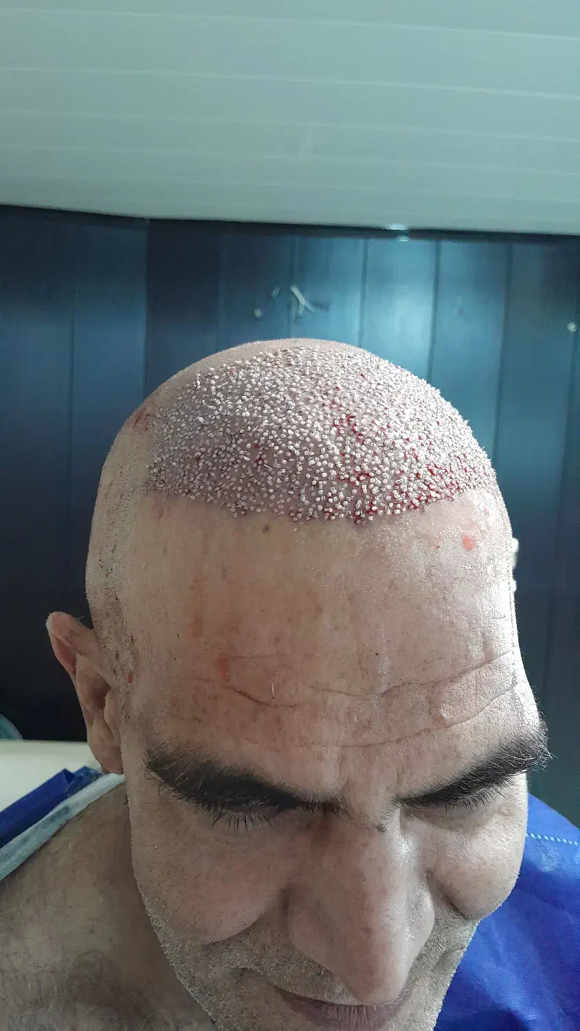 کاشت مو / ریش|خدمات آرایشگری و زیبایی|خرمآباد, |دیوار