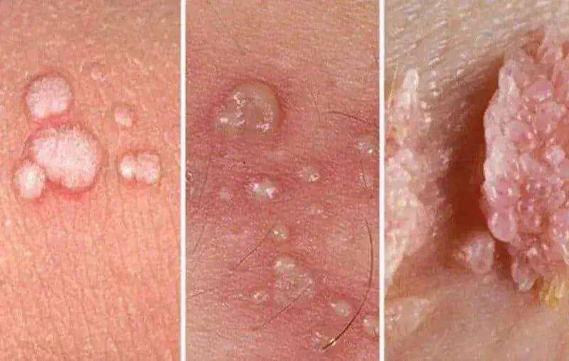 رفع دائمی زگیل وتبخال|آرایشی، بهداشتی، درمانی|قزوین, |دیوار