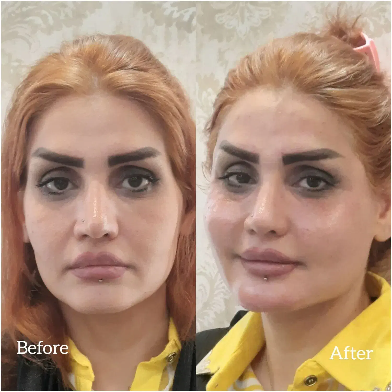 تزریق چربی|خدمات آرایشگری و زیبایی|تهران, تهرانسر مرکزی|دیوار