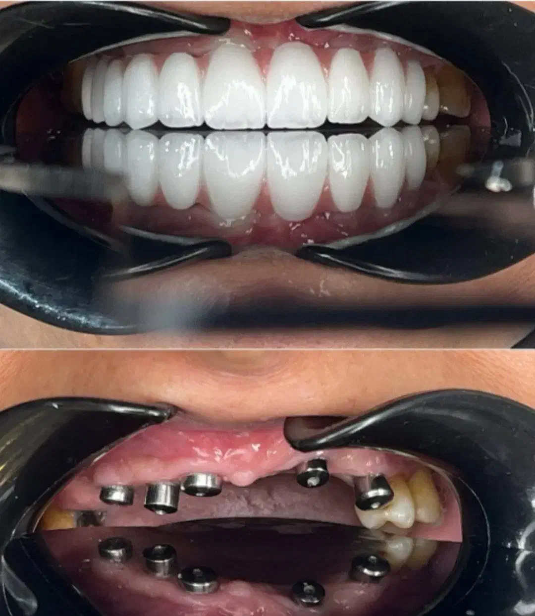 مرکز تخصصی دندانپزشکی ایمپلنت آلمانی(اقساط ۱۲ماهه)|خدمات آرایشگری و زیبایی|تبریز, |دیوار