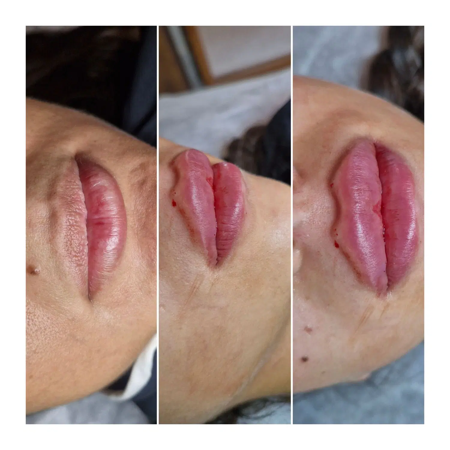 ژل/بوتاکس/فیلرلب هایفو/نخ/جوانسازتوسط پزشک کلینیک|خدمات زیبایی و سلامت|رشت, گلسار|دیوار