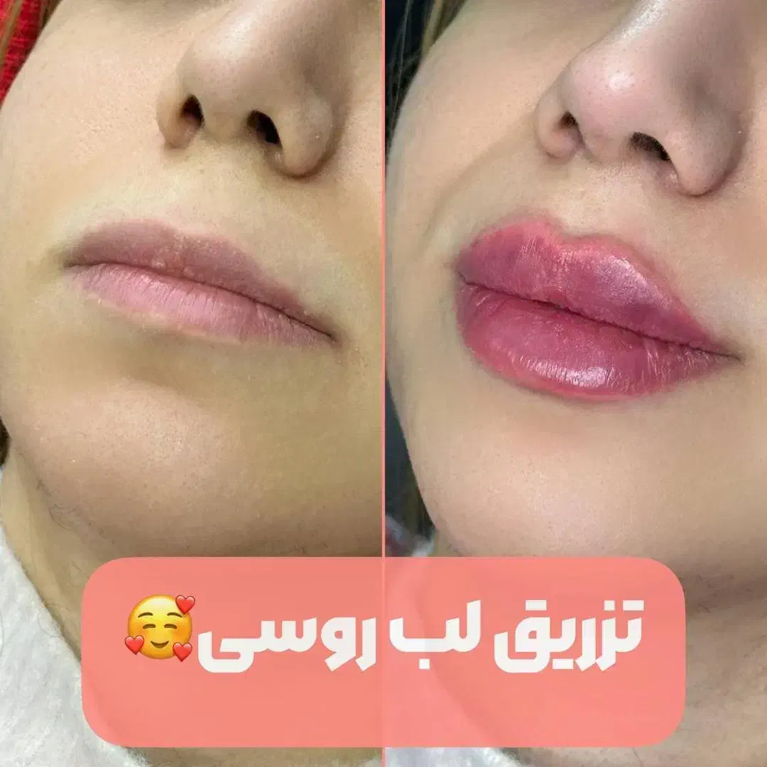 فیلرلب روسی ،گونه و زاویه،بوتاکس، فول فیس،زیرچشم|خدمات آرایشگری و زیبایی|شیراز, ستارخان|دیوار