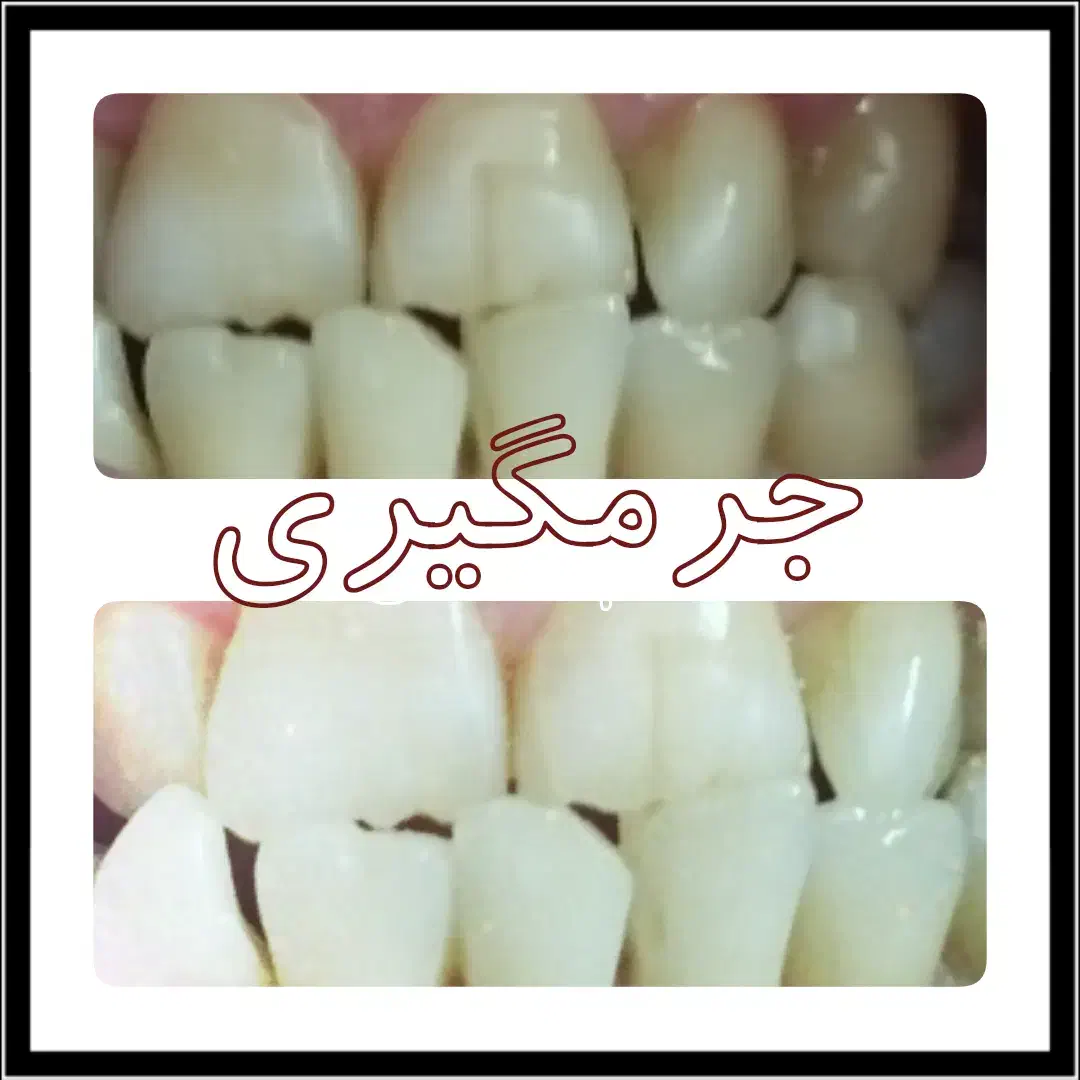 روکش دندان سرامیکی به مدت محدود|پزشکی|تهران, فردوس|دیوار