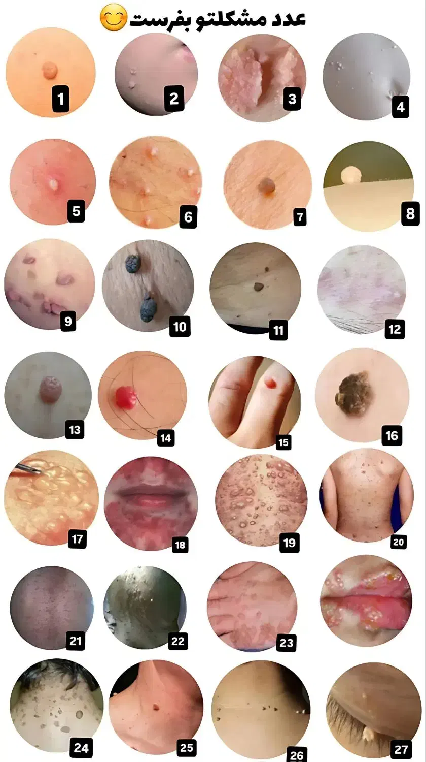 زگیل و تبخال hpv/hsv|آرایشی، بهداشتی، درمانی|اهواز, دانشگاه چمران|دیوار