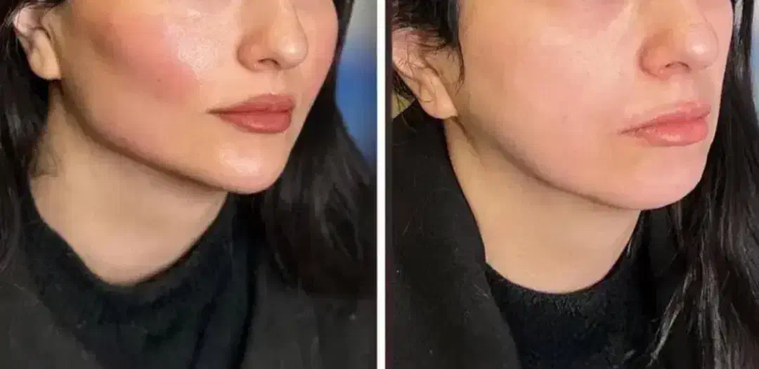 ژل ،فیلر و بوتاکس|خدمات آرایشگری و زیبایی|صفادشت, |دیوار