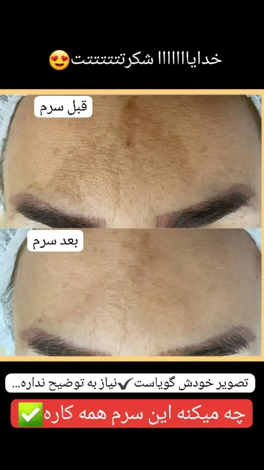 درمان تخصصی لک بدون لیزر|آرایشی، بهداشتی، درمانی|بوشهر, |دیوار