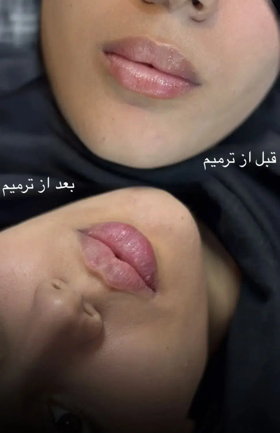 زیبایی چهره هارا ماندگار کن با بوتاکس و فیلر|خدمات آرایشگری و زیبایی|سبزوار, فرهنگیان|دیوار