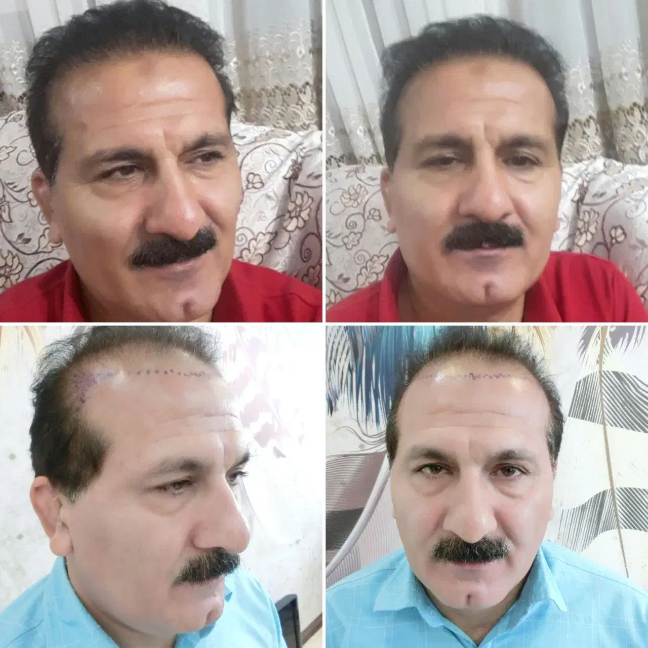 کاشت مو طبیعی سر و ابرو|خدمات آرایشگری و زیبایی|تهران, قیطریه|دیوار