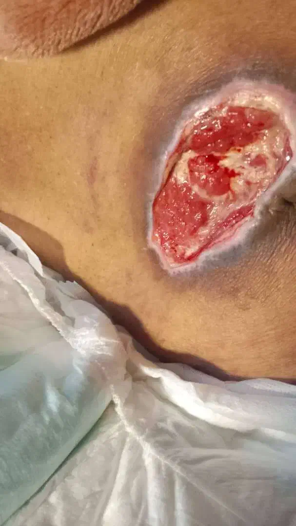 درمان نوین انواع زخم دیابتیک و بستر و جراحی و بخیه|خدمات آرایشگری و زیبایی|صومعهسرا, |دیوار