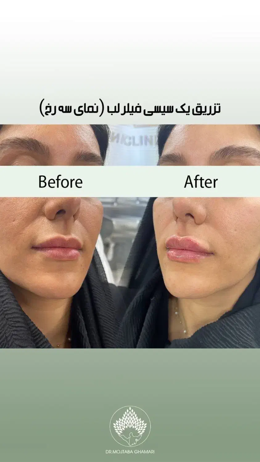 تزریق فیلر زیر چشم|خدمات آرایشگری و زیبایی|تهران, جردن|دیوار