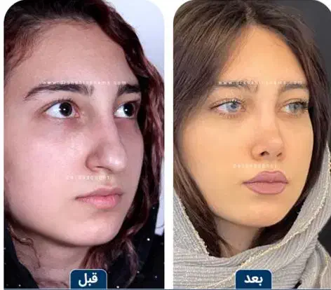 عمل بینی با چک و سفته|خدمات آرایشگری و زیبایی|تهران, زعفرانیه|دیوار