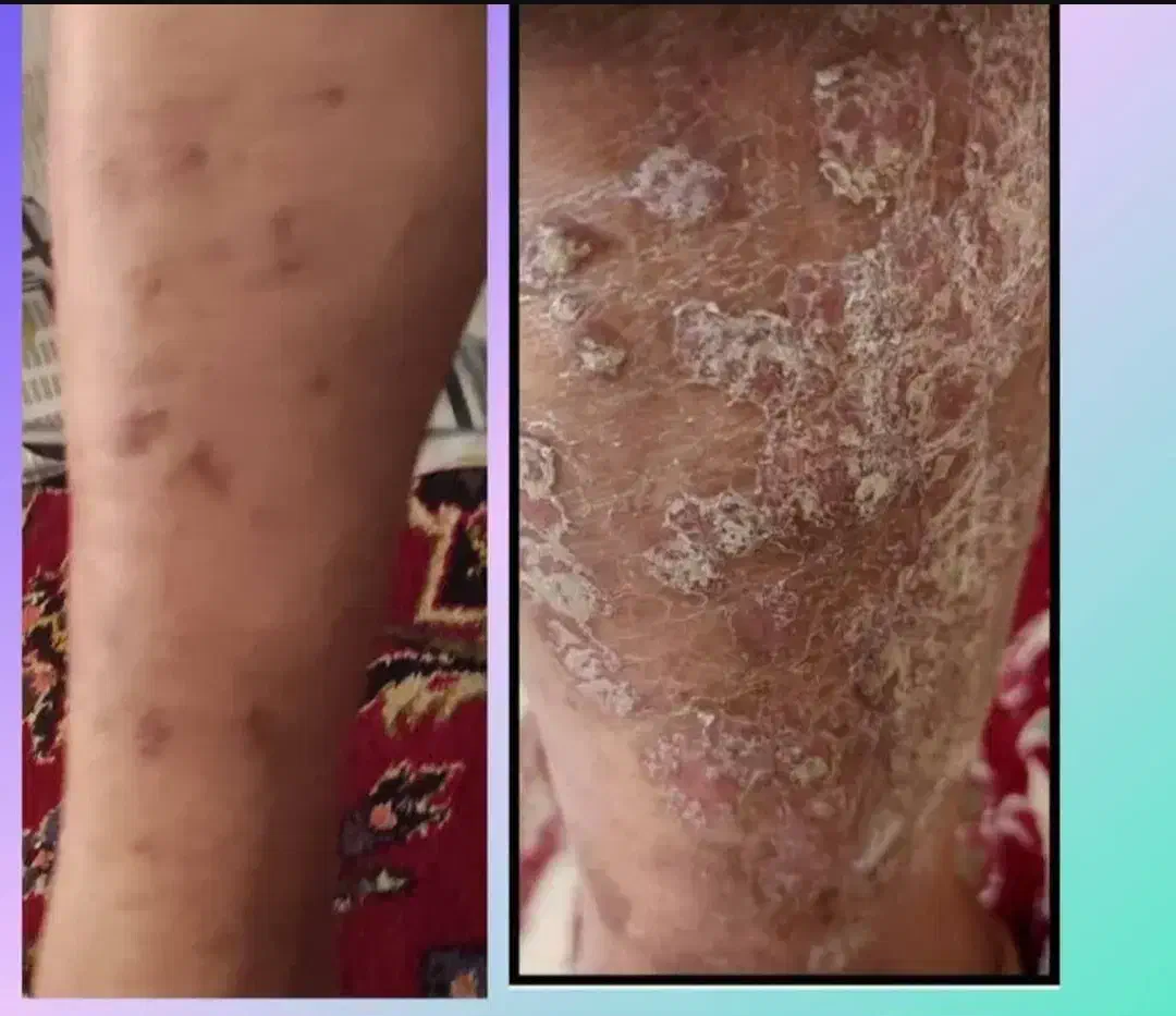 مشکلات پوستی و گرمای بدن|آرایشی، بهداشتی، درمانی|شیراز, لشکری‎|دیوار