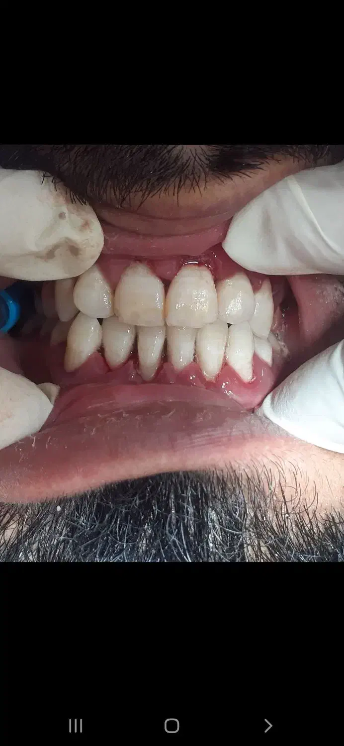 انجام جرمگیری هر فک فقط ۴۵۰ تومان در مطب شخصی|خدمات آرایشگری و زیبایی|زاهدان, |دیوار