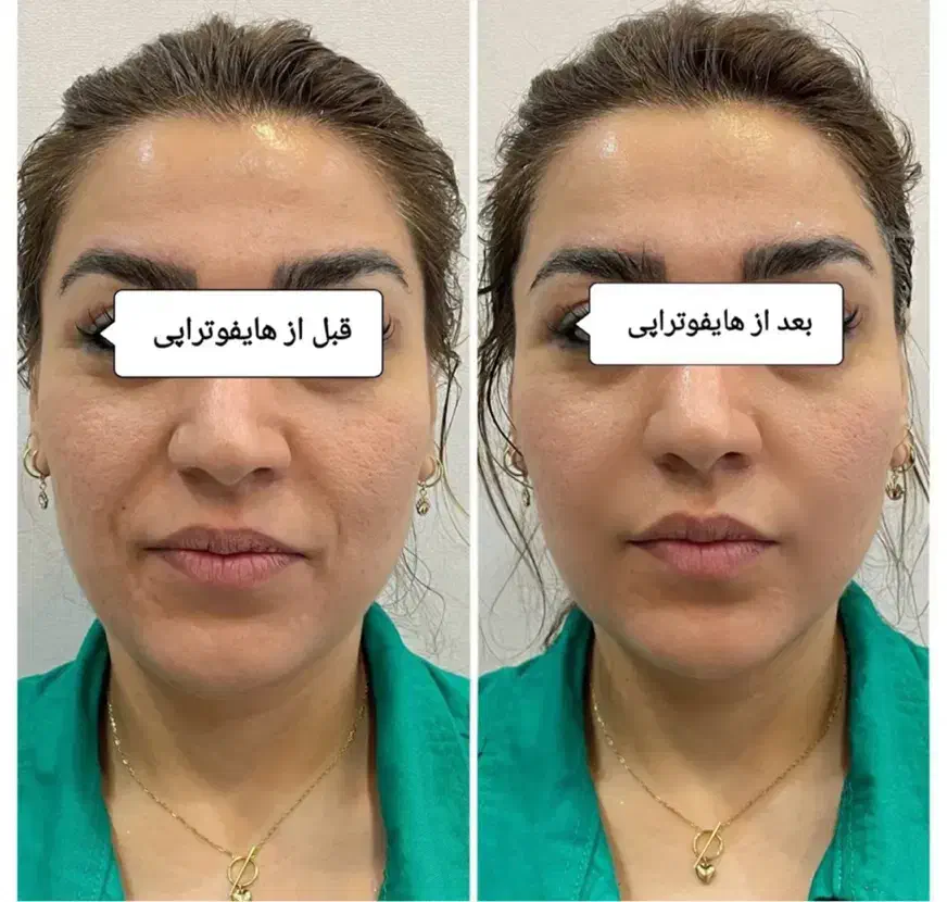 هایفو(لیفت صورت در یک جلسه)تخفیف ۵۰ درصدی|خدمات آرایشگری و زیبایی|مشهد, وکیل‌آباد|دیوار