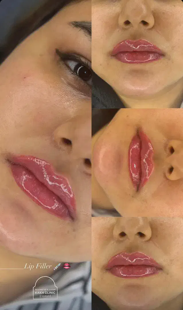 نیازمند مدل رایگان فیلر لب|خدمات آرایشگری و زیبایی|ساری, |دیوار