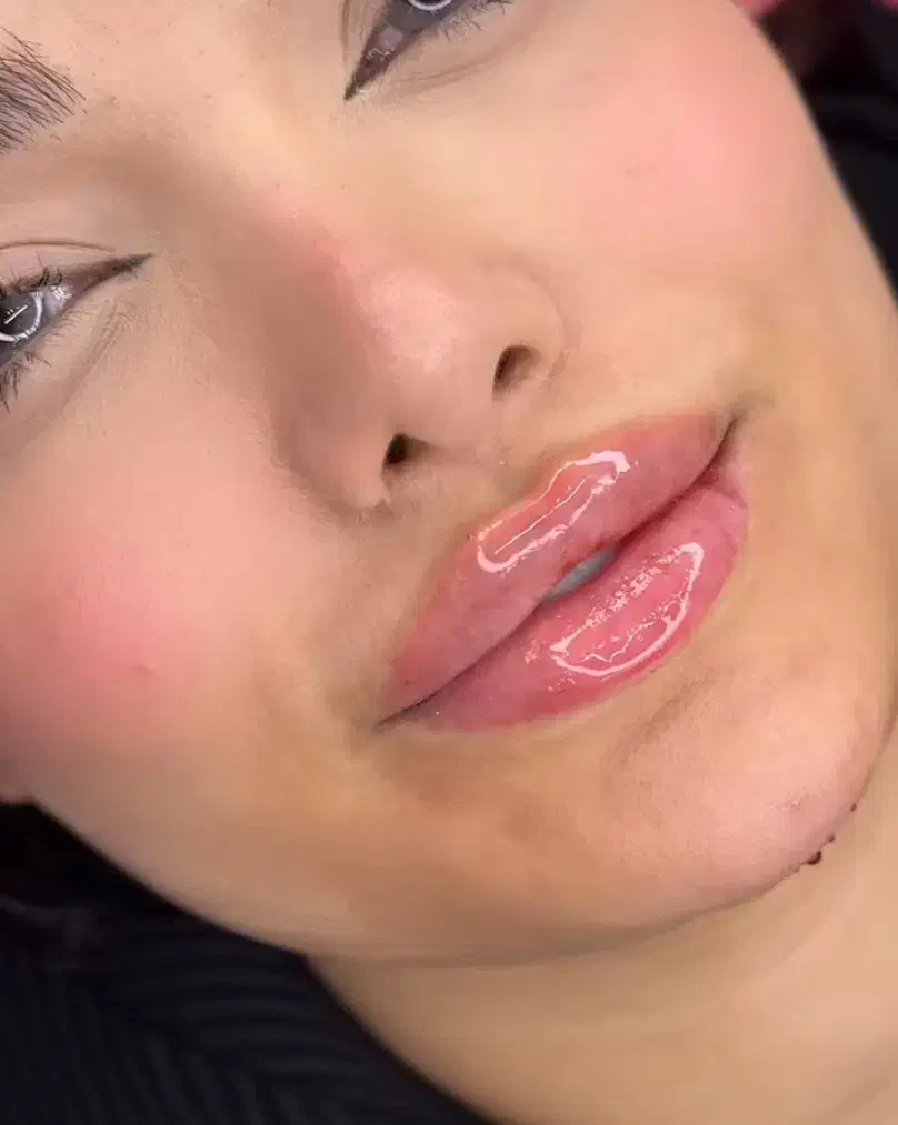 فقط امروز تزریق ژل با تخفیف عالی|خدمات آرایشگری و زیبایی|آبیک, |دیوار