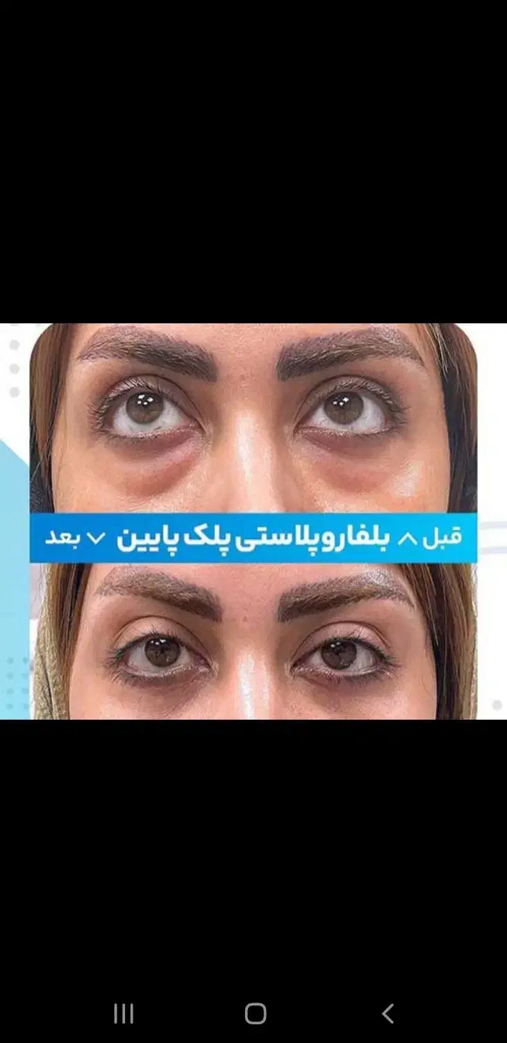 عمل زیبائی پلک پائین شامل پف ، چروک و...|خدمات آرایشگری و زیبایی|اصفهان, خلجا|دیوار