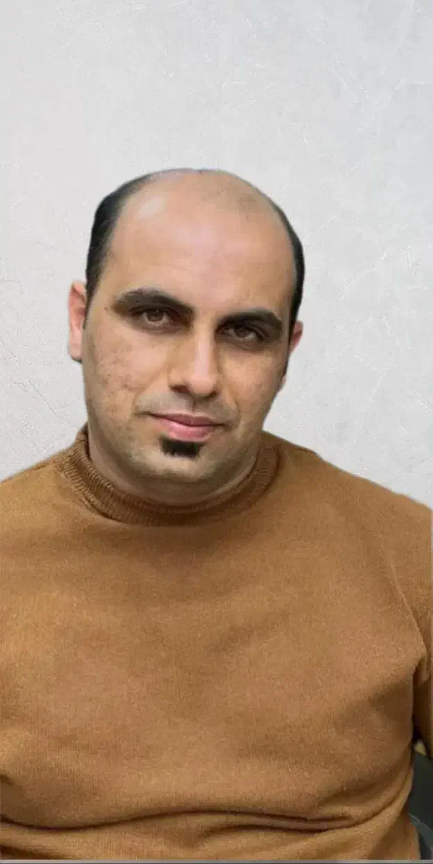 کاشت مو،ابرو،ریش|خدمات آرایشگری و زیبایی|بیرجند, |دیوار