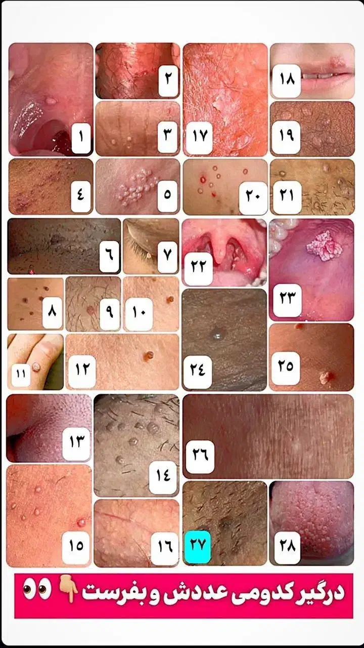 ازبین برندن زگیل تناسلی درکمتراز۱۵روزوبهبودی کامل|خدمات آرایشگری و زیبایی|گرگان, |دیوار
