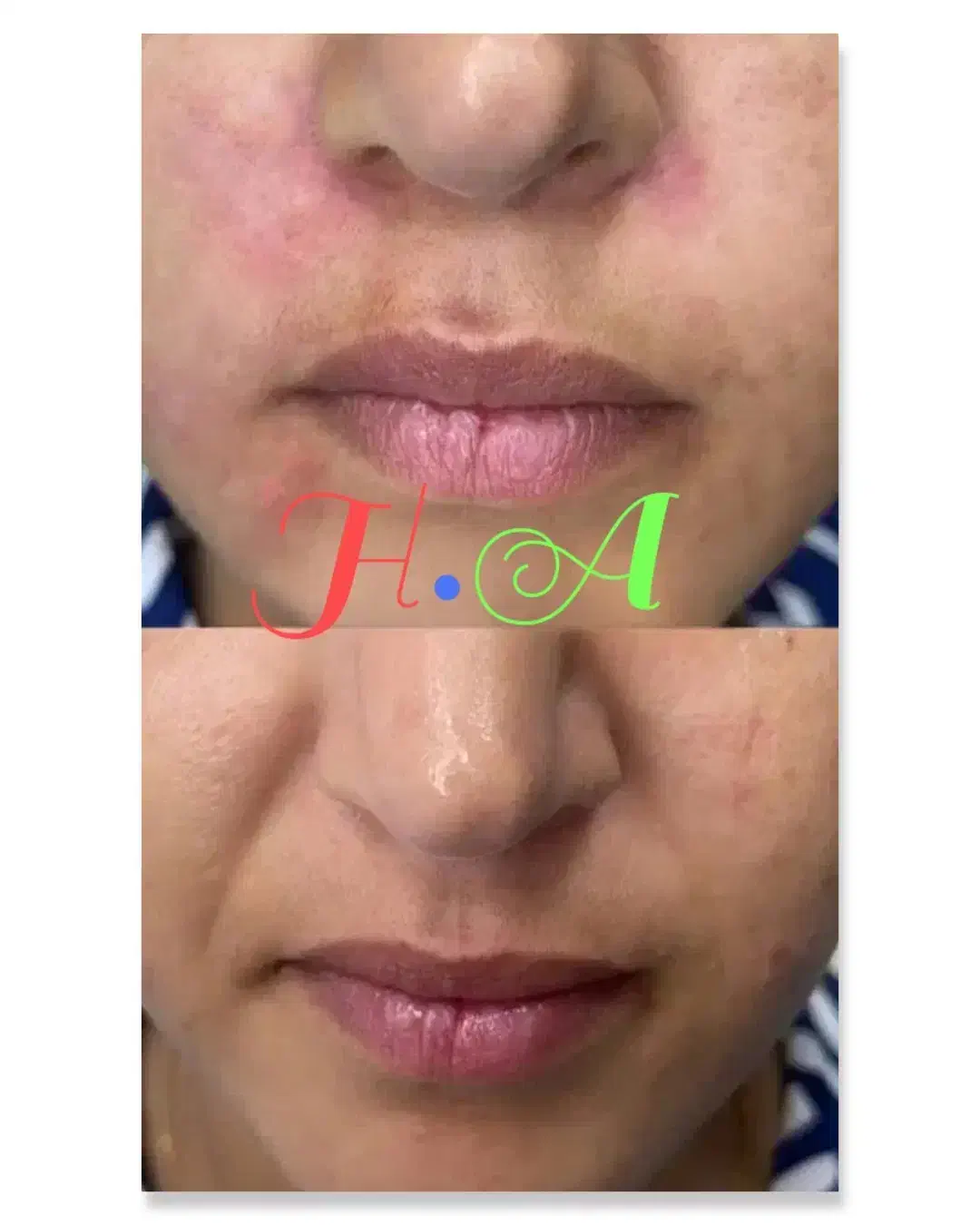 جشنواره ژل و بوتاکس درکلینیک پوست ومو|خدمات آرایشگری و زیبایی|شاهینشهر, فردوسی|دیوار