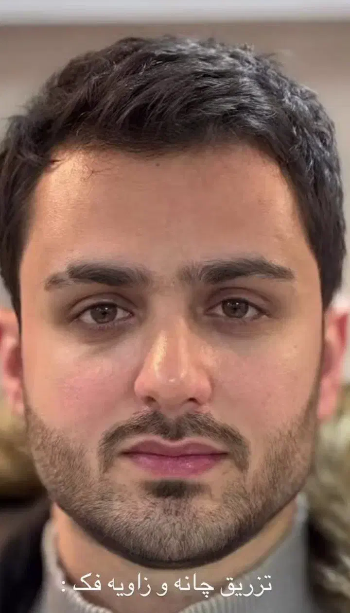 تزریق و اموزش ژل و بوتاکس|خدمات آرایشگری و زیبایی|کرمانشاه, |دیوار