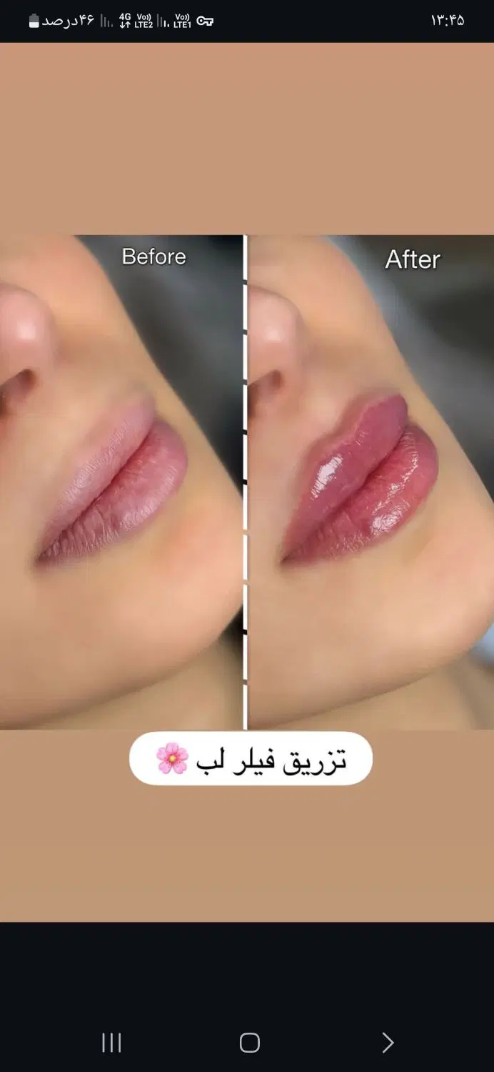مدل برای فیشال درمانی و آبرسانی و ژل و بوتاکس|استخدام درمانی، زیبایی، بهداشتی|تهران, یاخجی آباد|دیوار