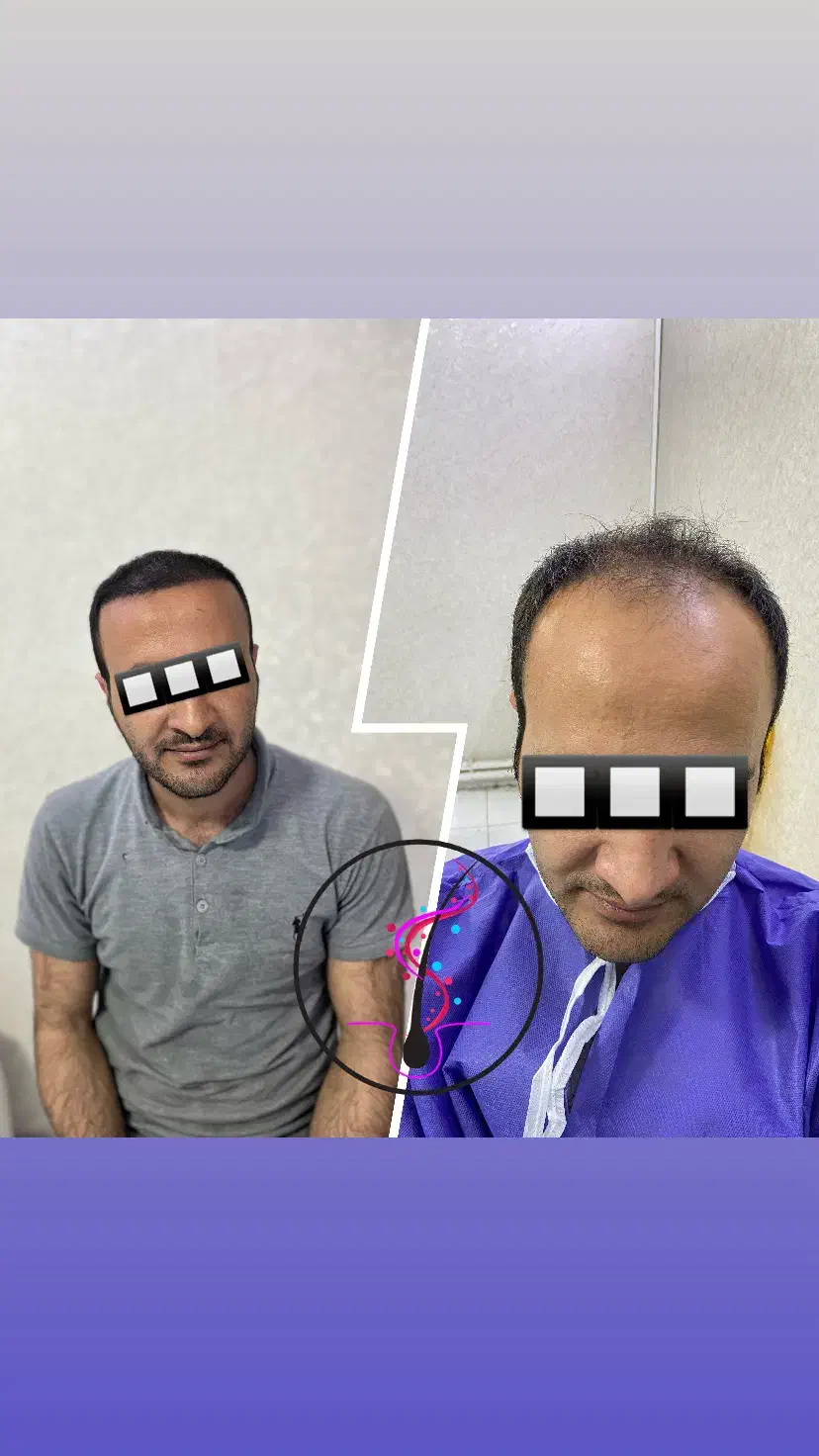 کاشت مو با شرایط اقساط تضمینی|خدمات آرایشگری و زیبایی|اردبیل, |دیوار