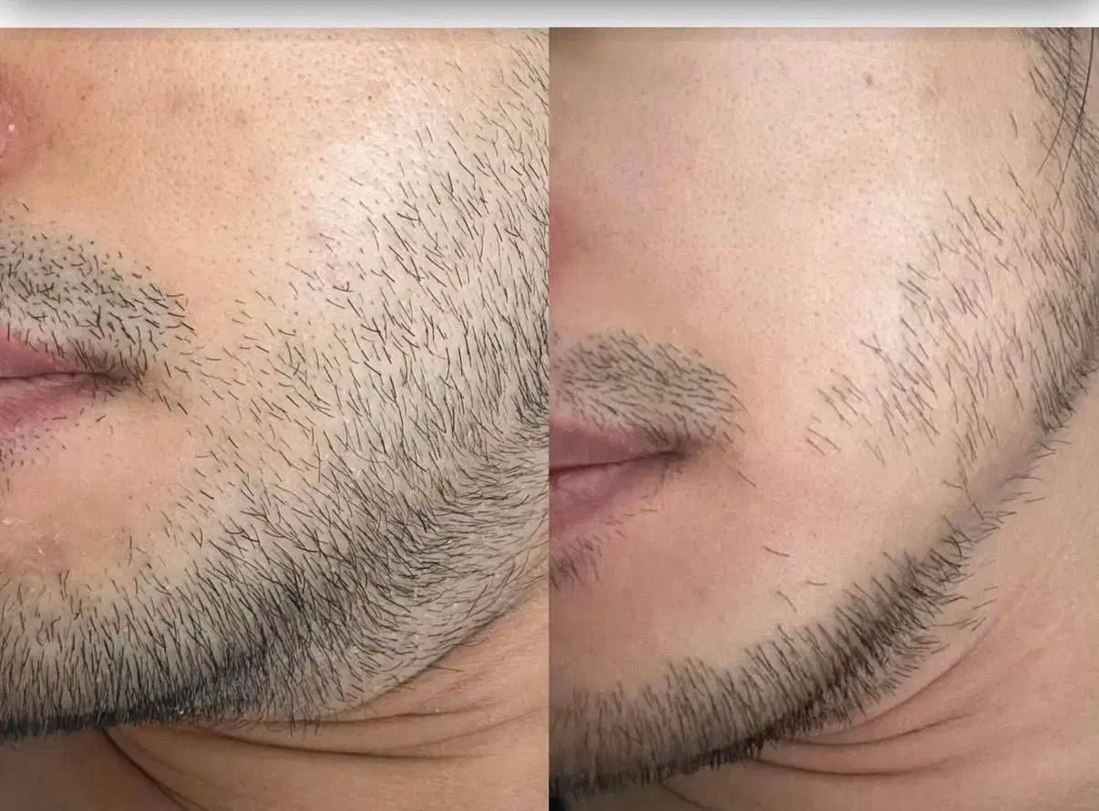 تغییر چشمگیر در ظاهر صورت (ضمانت کیفیت)|آرایشی، بهداشتی، درمانی|تهران, شوش (باغ آذری)|دیوار
