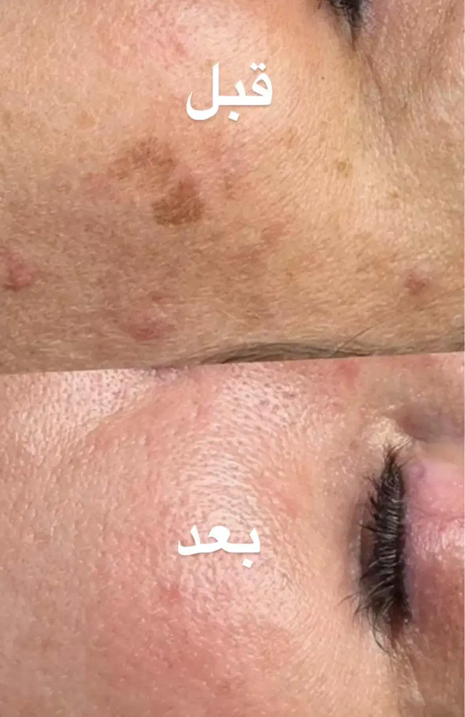 خال برداری و رفع کک ومک|خدمات آرایشگری و زیبایی|رشت, رودباری|دیوار