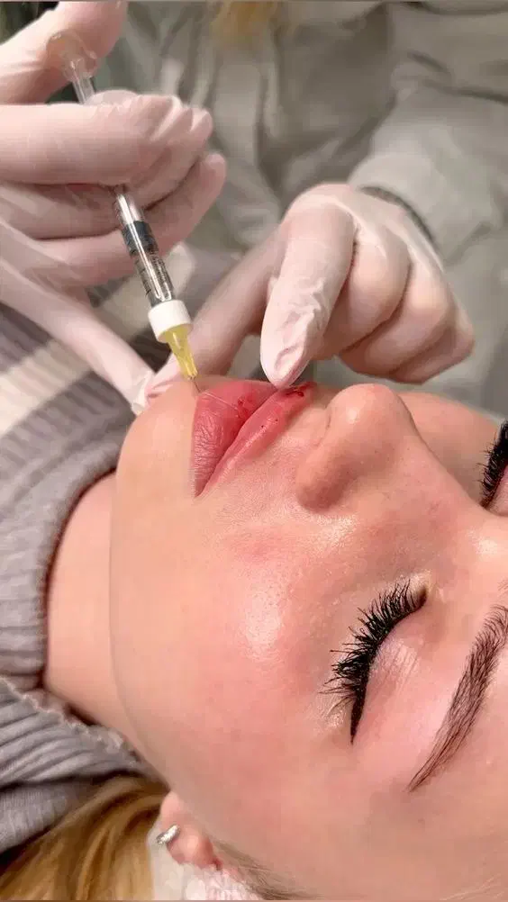 تخفیف ویژه بوتاکس و فیلر در کلینیک پزشکی زیبایی|خدمات آرایشگری و زیبایی|رشت, انصاری|دیوار